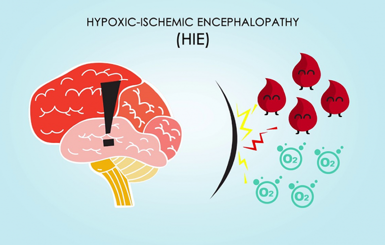 Stem Cell Therapy for Hypoxic-ischemic Encephalopathy – Shop – Dr ...