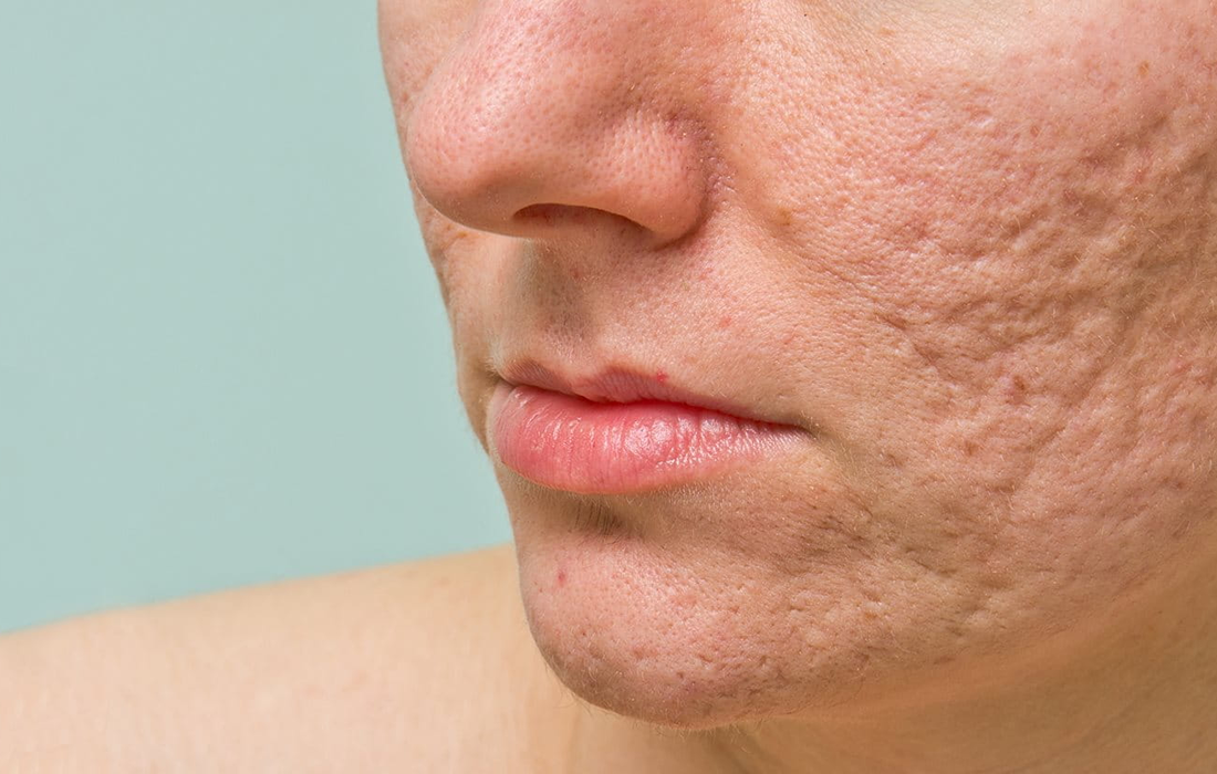 How Fat Cells in the Skin Help Fight Acne - Dr. Ramon - Ramon De La Puerta, MD