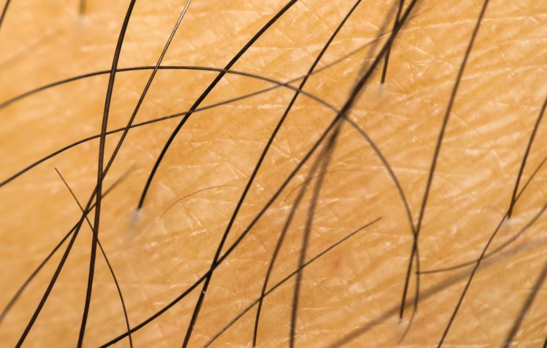 Hair Follicle Transplants Can Promote Scar Rejuvenation - Dr. Ramon - Ramon De La Puerta, MD