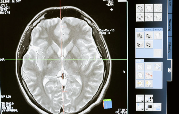 Neuroinflammation and Alzheimer&#8217;s Disease - Dr. Ramon - Ramon De La Puerta, MD